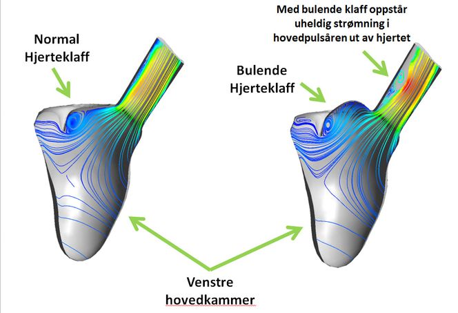 Forskerne har kjørt studier av både veneplassering, klaffeplassering og hvordan ulik form på klaff påvirker blodstrømningen i hjertet. Modellene viser hvordan endret klaffegeometri endrer strømningen ut av hjertet og ut hovedpulsåren. Dette kan ha betydning for hvem som bør opereres og valg av operasjon.