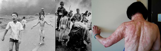 Til venstre: Det ikoniske bildet som Nick Ut tok for AP i 1972. Kim Phuk har fått Napalm over hele ryggen, som du kan se i midten har det brent bort huden. Til høyre: Kim Phuc viser hvordan ryggen hennes ser ut i 2015 etter laserbehandling for å bedre på arrene hun fikk.  Bilde:  Nick Ut via NTB Scanpix.