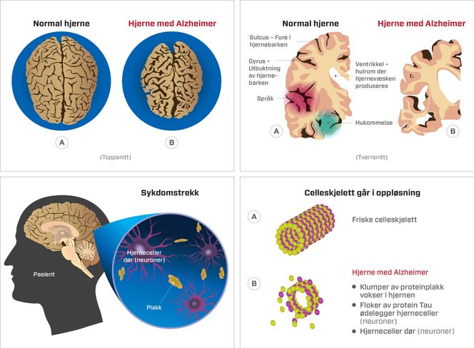 I en hjerne med fremskreden Alzheimer er mye av hjernevevet borte som følge av nedbryting av hjernecellene. Det fører til gradvis tap av minne og kognitive evner. Til slutt er tapet så stort at pasienten dør.