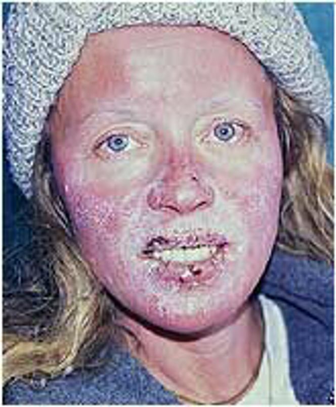 Deltaker Tina Sjögren med frostskader.