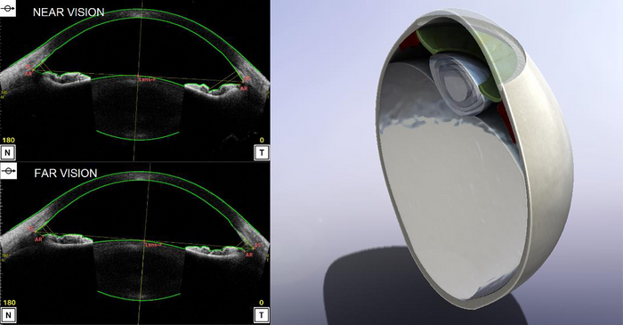 <strong>Figur 4:</strong> Fra målinger til simulering. Venstre: Et typisk resultat fra en optisk koherenstomografi (OCT) av et øye. Høyre: Et tverrsnitt av 3D-modellen basert på målinger fra OCT-bildene, laget i Solidworks®.