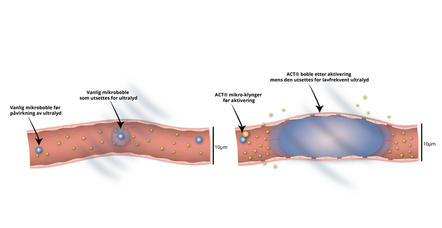 Her kan du sammenlikne størrelsen på vanlige mikrobobler som er laget for ultralydavbilding og den store «Acoustic Cluster Therapy»-boblen som er i direkte kontakt med store deler av blodåreveggen. Illustrasjon:  Exact Therapeutics